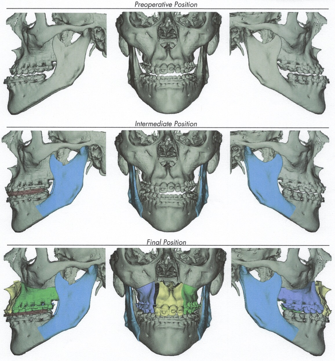 Jaw surgery planning